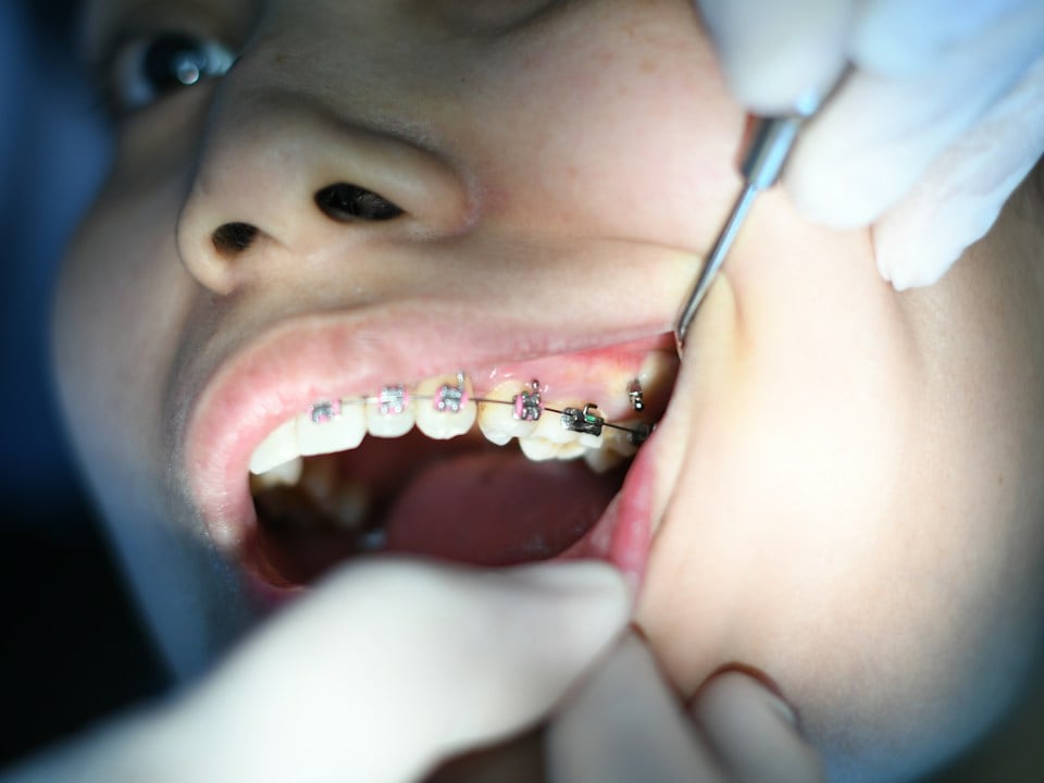 Braces & Orthodontics